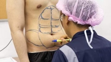 Een permanente sixpack middels implantaten? Het kan in Thailand!