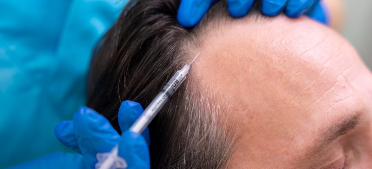 Hoe duur is een haartransplantatie voor mannen?